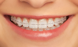 ceramic braces